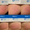 201903_Before+AfterPhotos_PreviewImage_Psoriasis_1200x627 New Jersey